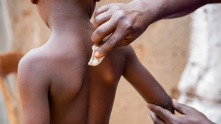 Omar Kagoma shows the marks on the skin of his six-year-old son Moussa Niyonkuru, after he recovered from Mpox, outside their house in Kinama zone, in Bujumbura, Burundi, August 28, 2024. Photo: REUTERS/Ngendakumana Evrard